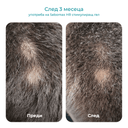 Третиране на коса с sebomax hr стимулиращ гел против косопад и алопеция ареата при жени и мъже